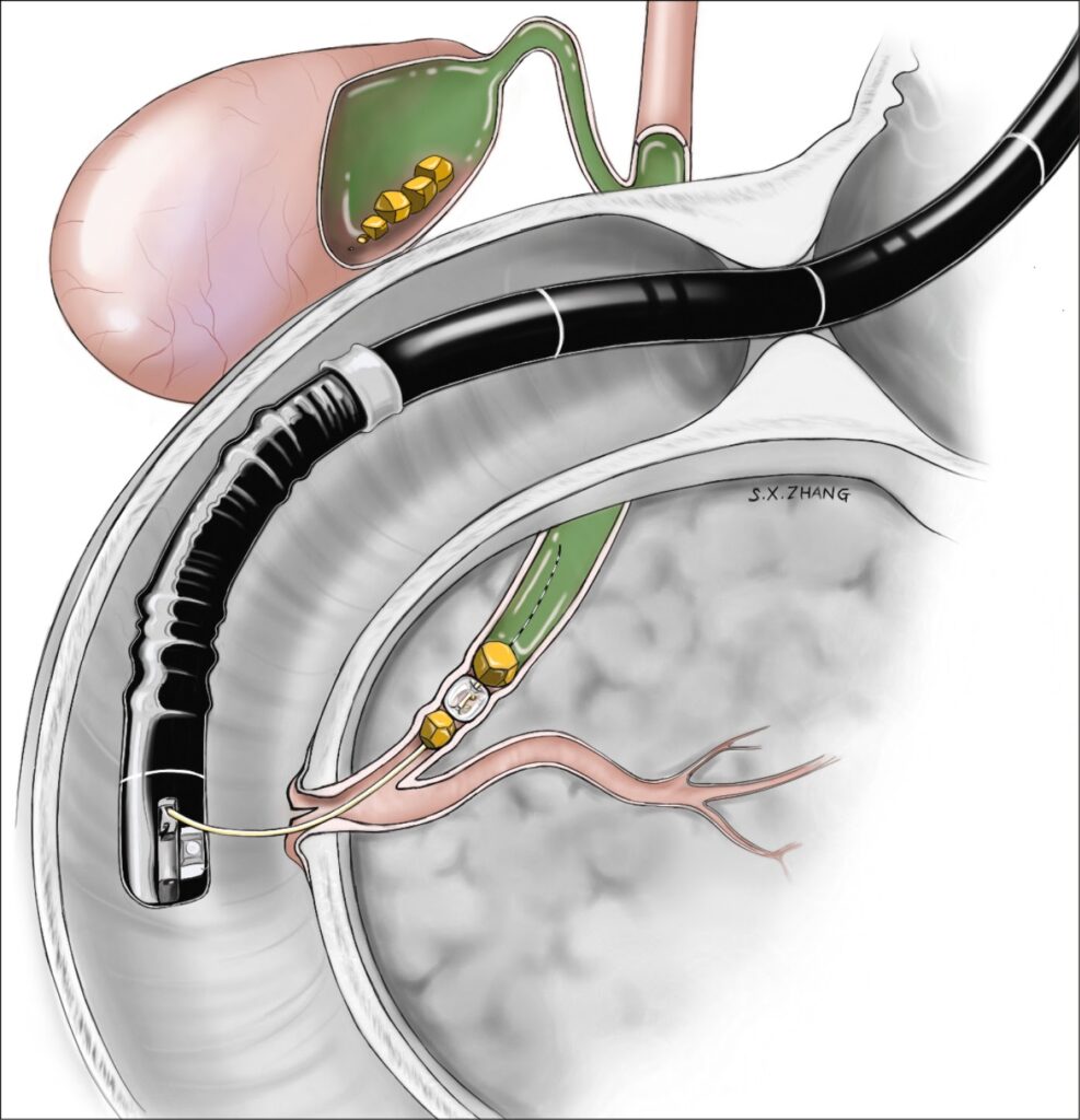 ERCP